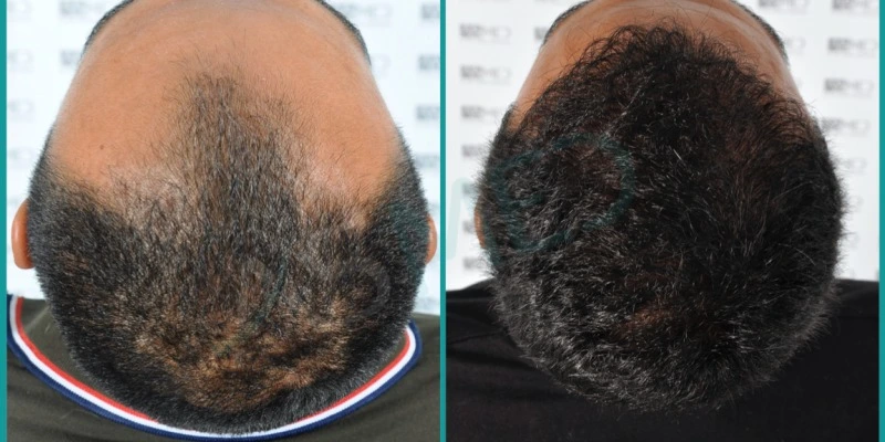 Hair Restoration Plantation, FL
